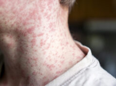 Measles outbreak investigation in Utah blocked by patient who refuses to talk Measles outbreak investigation in Utah blocked by patient who refuses to talk