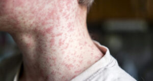 Measles outbreak investigation in Utah blocked by patient who refuses to talk Measles outbreak investigation in Utah blocked by patient who refuses to talk