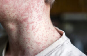 Measles outbreak investigation in Utah blocked by patient who refuses to talk Measles outbreak investigation in Utah blocked by patient who refuses to talk