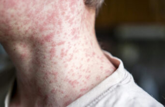 Measles outbreak investigation in Utah blocked by patient who refuses to talk Measles outbreak investigation in Utah blocked by patient who refuses to talk